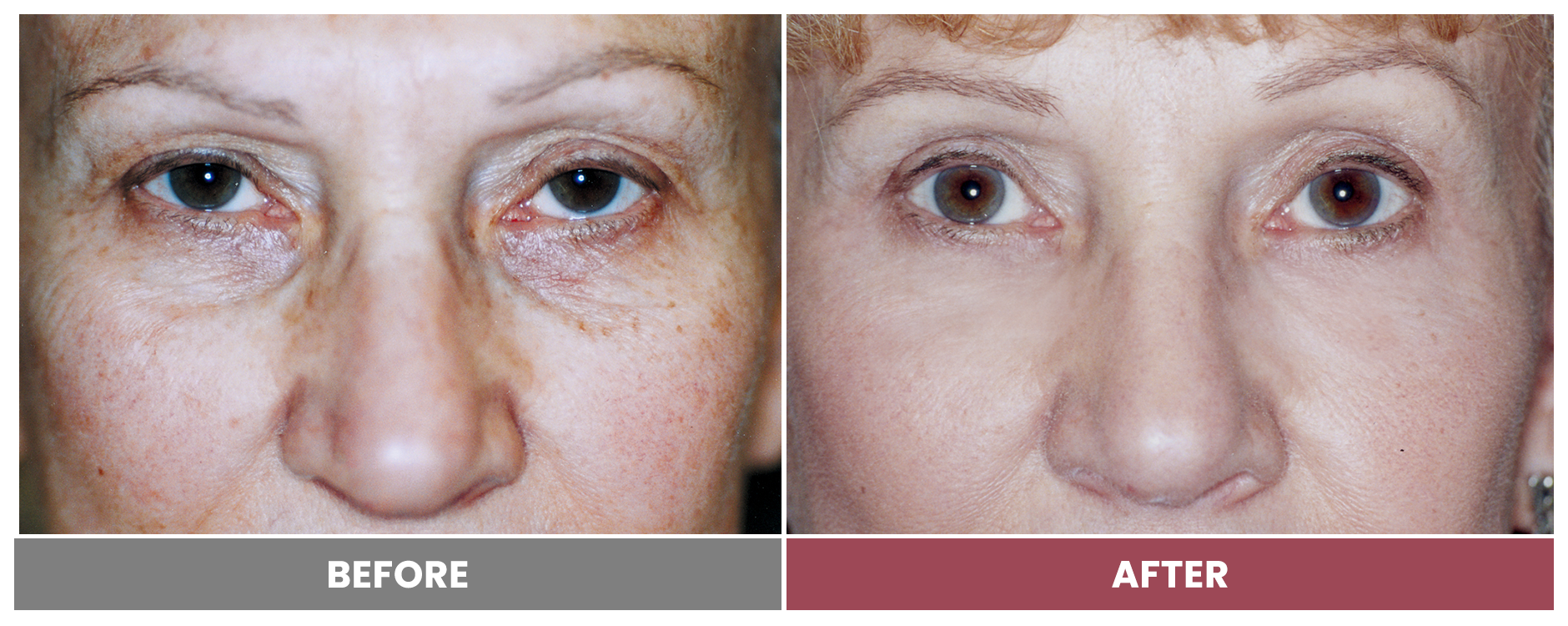 LASER SKIN RESURFACING - Case 6